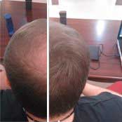 Фотография головы Перцова Дмитрия до и после использования расчески Power Grow Comb