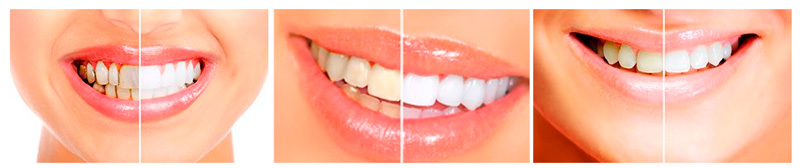 До и после отбеливания зубов