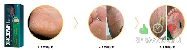 Π³ΡΠΈΠ±ΠΎΠΊ Π½ΠΎΠ³ΡΠ΅ΠΉ ΠΈ ΡΡΠΎΠΏ