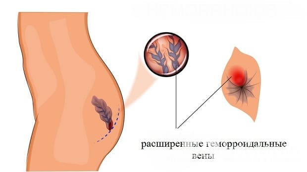 Лечение геморроя