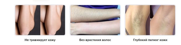 удаление волос