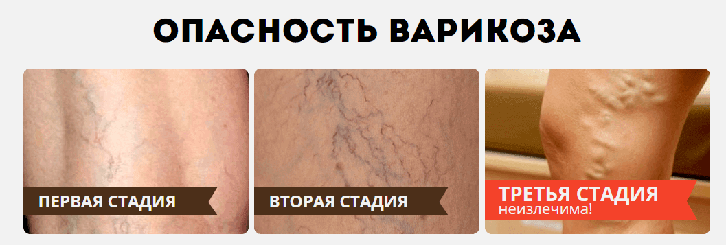 Опасность варикоза Опасность варикоза