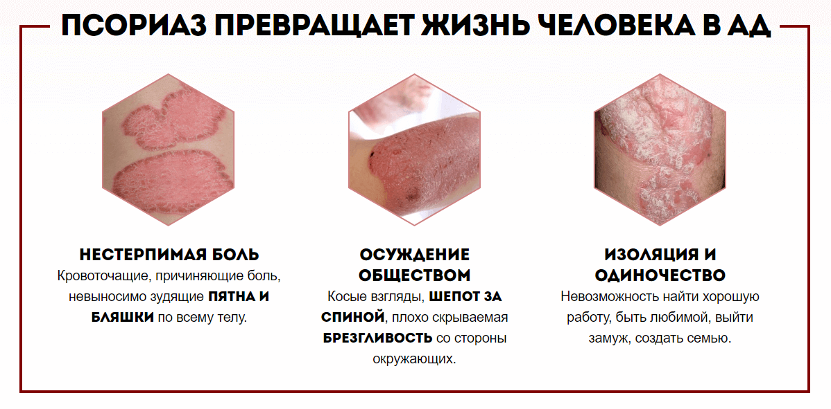 Последствия псориаза Последствия псориаза