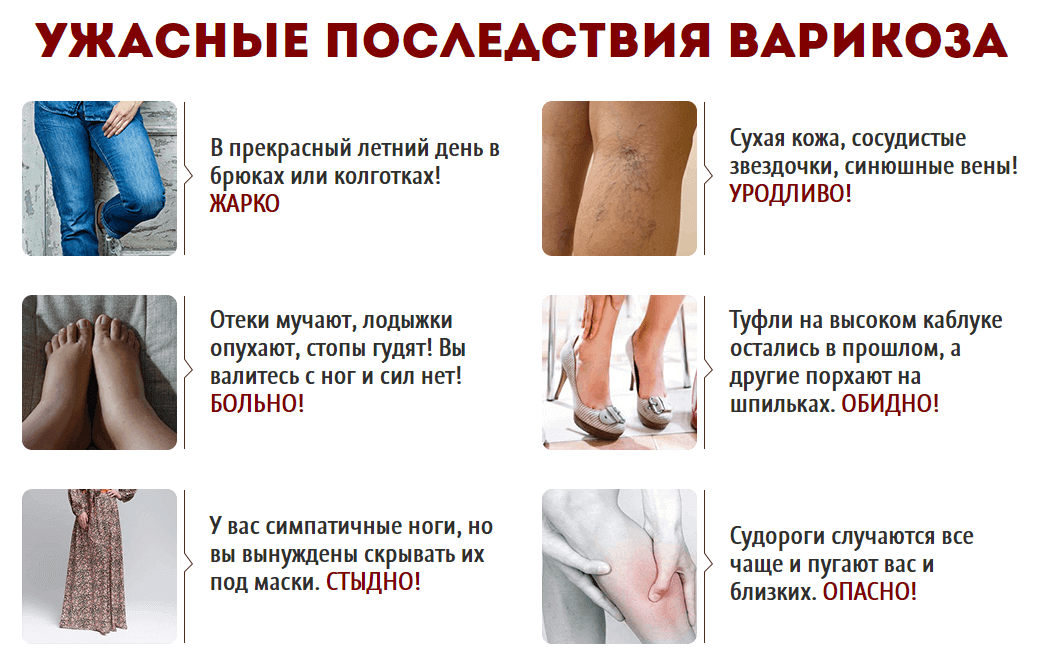 Последствия варикоза Последствия варикоза