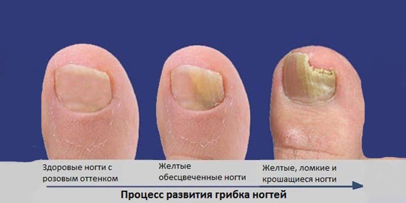 Долгар от грибка ногтей