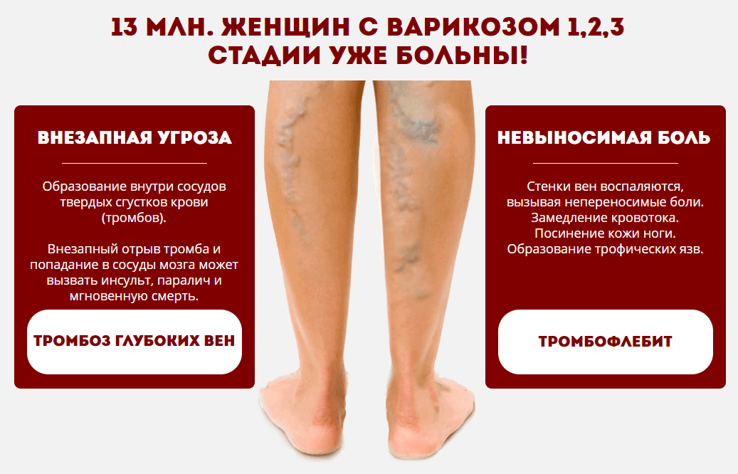 Заболеваемость варикозом Заболеваемость варикозом